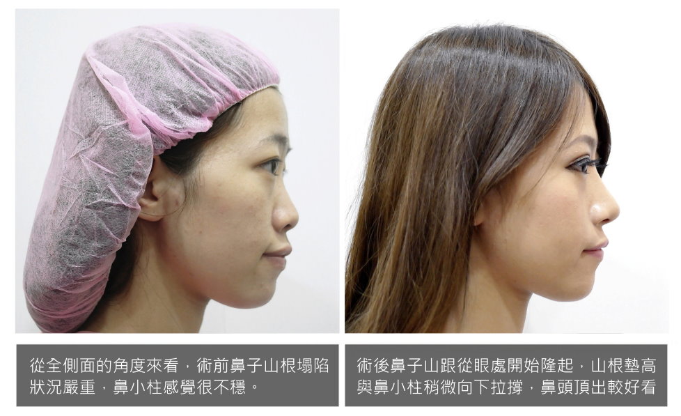 隆鼻側面,隆鼻前後比對,隆鼻質感提升,隆鼻模特兒,隆鼻小模