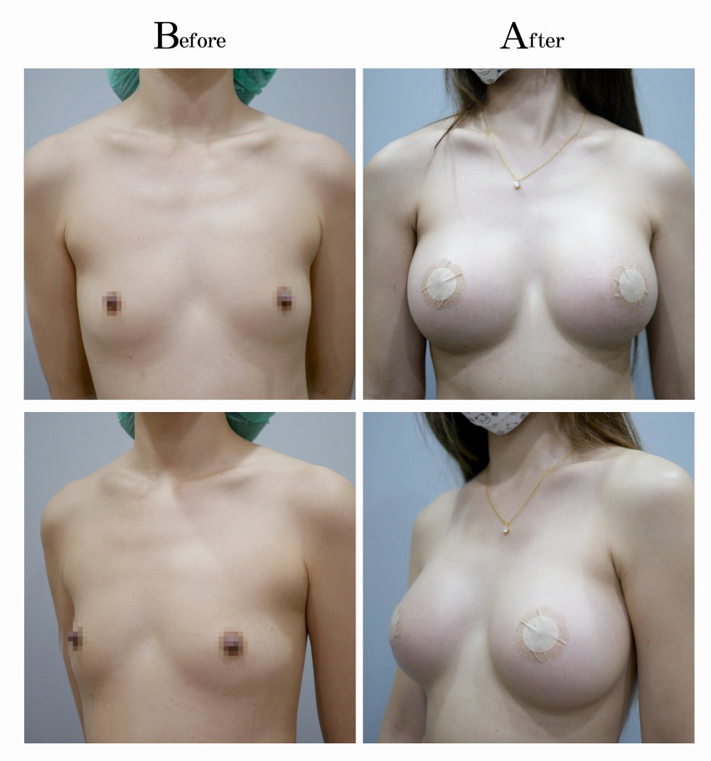 水滴型隆乳手術