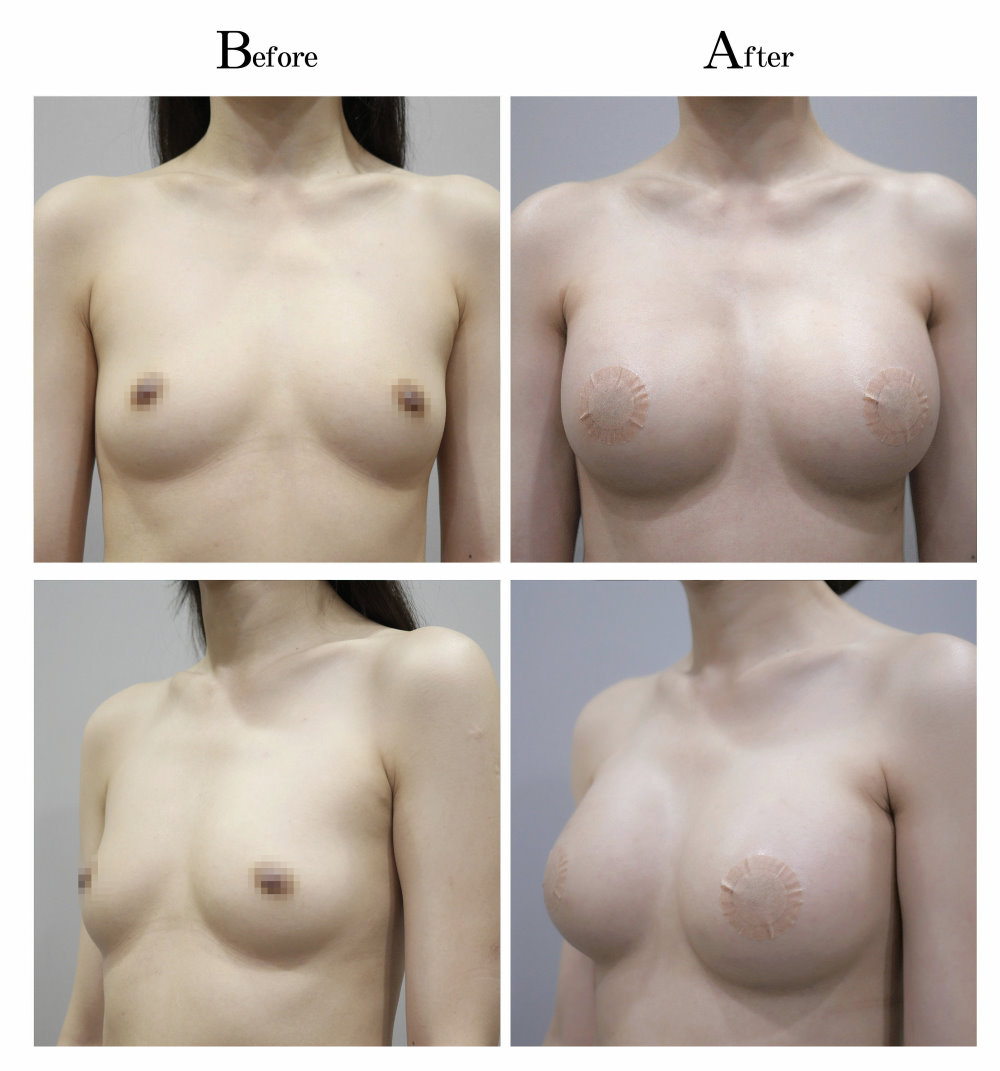 水滴型隆乳手術