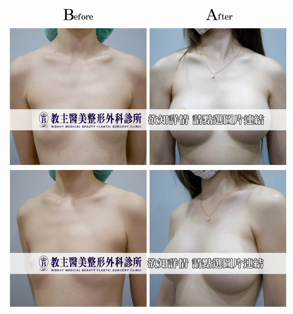 隆乳,豐胸,乳房整形,乳房重建,美胸隆乳