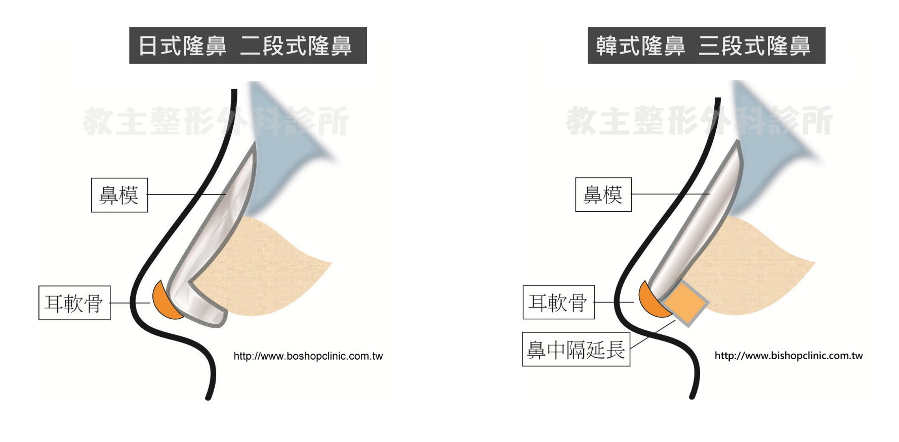 鼻整形分類,隆鼻術式,日式鼻雕二段式隆鼻,韓式隆鼻三段式隆鼻